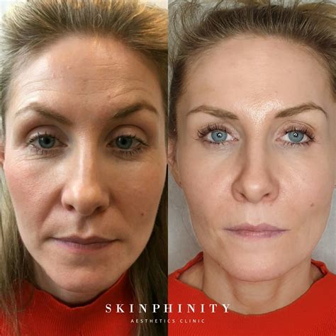 Botox Anti Wrinkle Injections Tarporley Cheshire Skinphinity