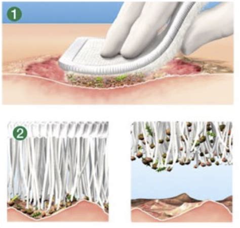 Wound Treatment Part 2 Debridement And Dressings Flashcards Quizlet