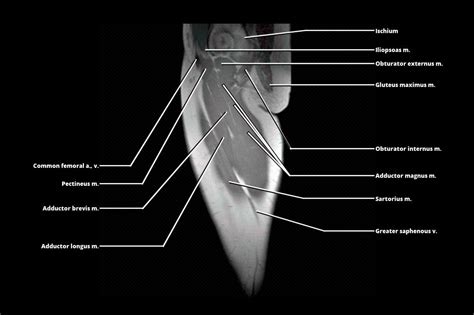 MRI - THIGH