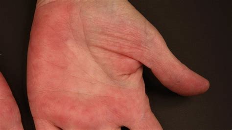 Erythema Hands