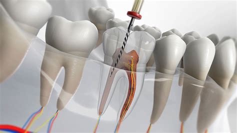 Endodoncia Tratamiento De Conducto Consultorio Mb Odontolog A