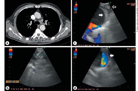 Figure 1 From Intramural Hematoma Of The Pulmonary Artery And