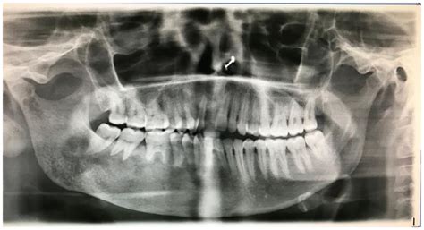 Fibrous Dysplasia Of Maxilla