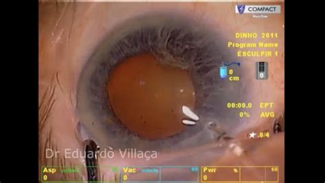 Cirurgia de Vitrectomia Consolação CENTRO CIRÚRGICO BELA VISTA