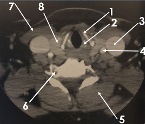 Soft Tissue Neck C Spine CT Image 4 Diagram Quizlet