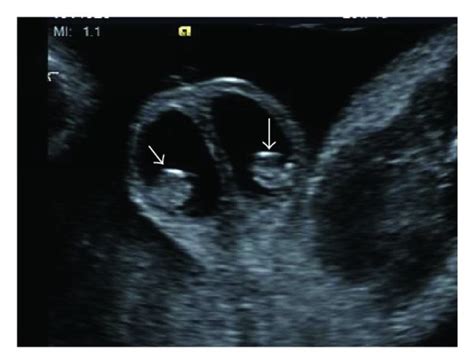 Prenatal Ultrasonographic And Postnatal Radiographic Findings Prenatal