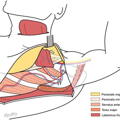 Anatomy Of Dissection For Pedicled Latissimus Dorsi Flap Demonstrating