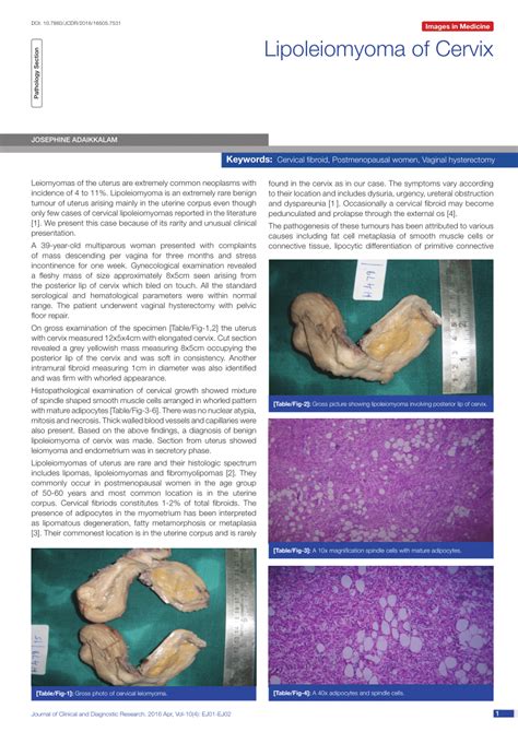 PDF Lipoleiomyoma Of Cervix