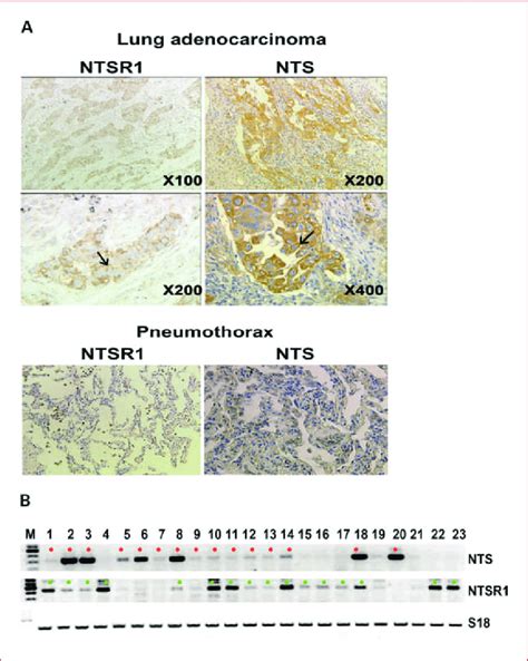 Neurotensin Nts And Ntsr1 Expression In Patients With Primary Lung