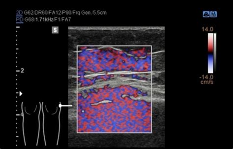Doppler artifacts Flashcards | Quizlet 