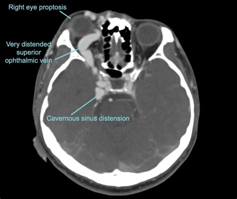 CT Case 008 LITFL CT Scan Interpretation