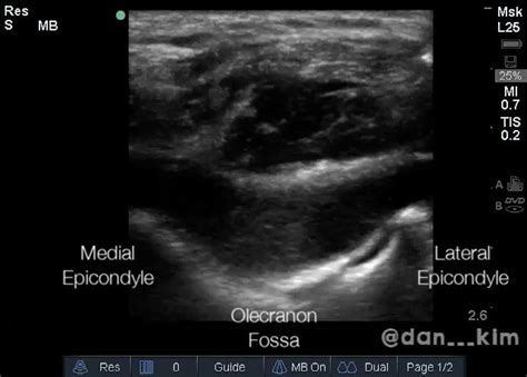 Dan Kim On Twitter Elbow Arthrocentesis With POCUS Probe Oriented