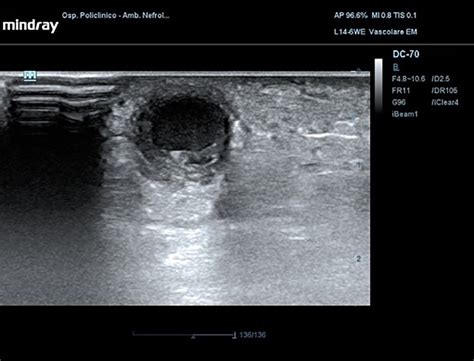 Thrombosis of the basilic vein observed with a linear probe in... | Download Scientific Diagram