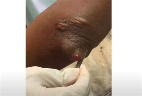 Large Infected Cyst on Arm Incision and Drainage : r/pimplepopperdelight