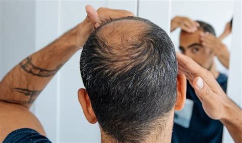 Men Using Finasteride For Hair Loss At Risk Of Missing Prostate