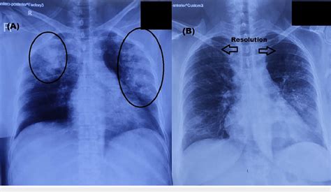 Chest X Ray Images Of The Patient A On Presentation Ill Defined