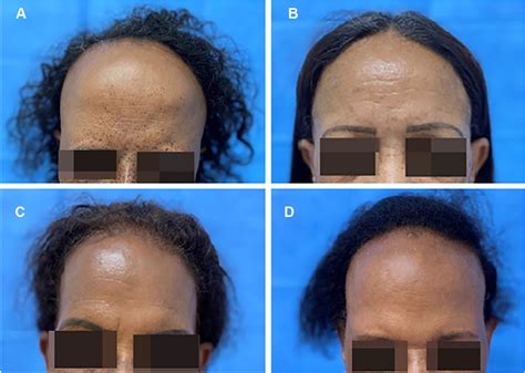 Scielo Brasil Frontal Fibrosing Alopecia Report Of Four Sisters