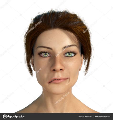 Facial Nerve Paralysis Bell's Palsy Illustration Showing Female One