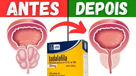 Tadalafila Para Pr Stata Inchada Tratamento Para Hiperplasia