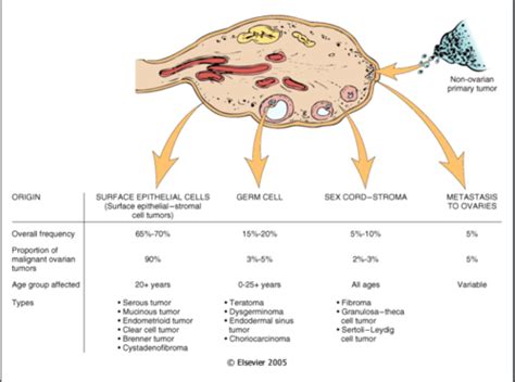 Ovarian Cancer Flashcards Quizlet
