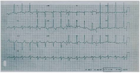 Acute Pulmonary Edema Secondary To Pregnancy In A Patient With The