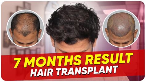 Hair Transplant Time Lapse Step By Step Hair Transplant Surgery Time