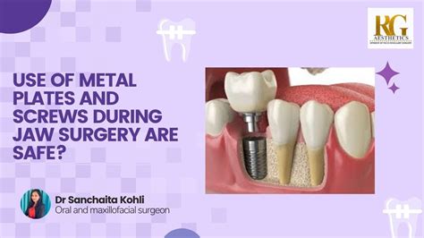 Use Of Metal Plates And Screws During Jaw Surgery Are Safe Dr