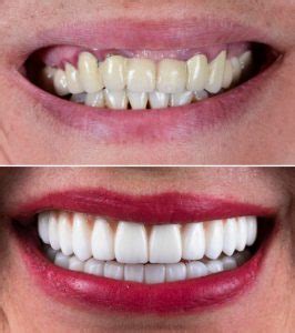 Turkey Veneers Before and After – Parmire