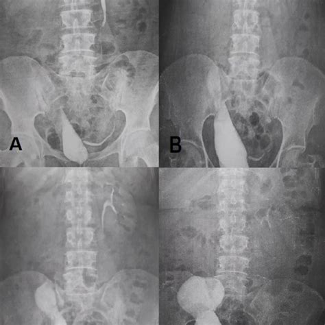 Intravenous Pyelogram Ivp Before Calicovesicostomy Surgery The