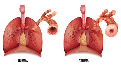 Asma Y La Dificultad Respiratoria Salud Net Ar