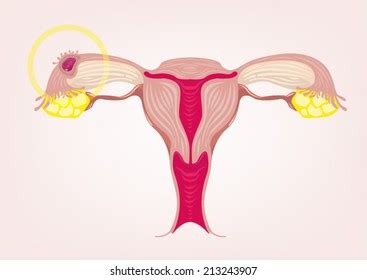 Ectopic Pregnancy Concept Vector Illustration Stock Vector Royalty