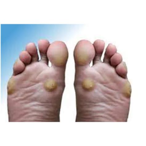 Foot Corn treatment in homeopathy, Packaging Size: Small Box | ID ...