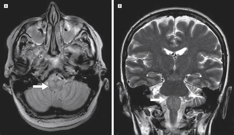 Progressive Ataxia And Palatal Tremor Movement Disorders JAMA