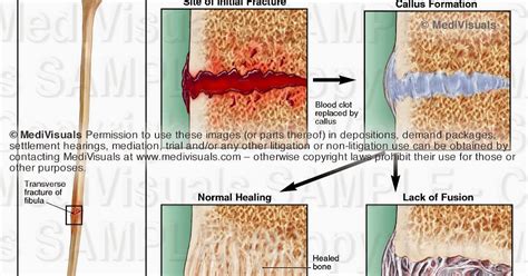 The Medical Legal Exhibit Expert Blog: Complications Associated with ...