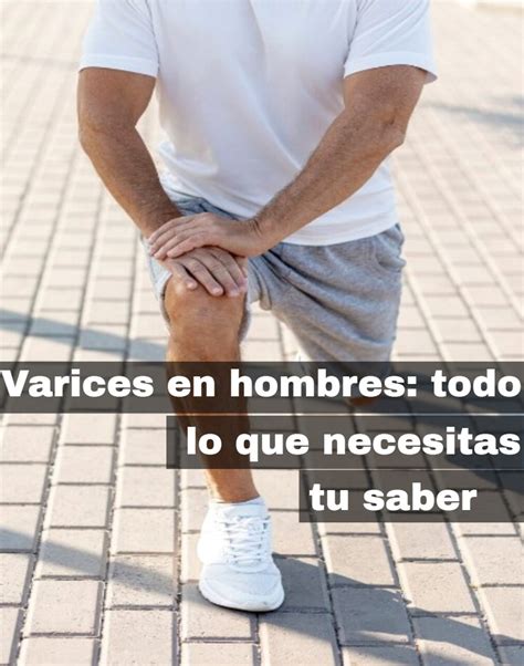 Varices En Hombres Todo Lo Que Necesitas Saber