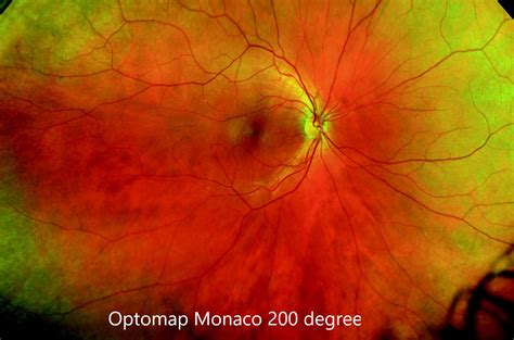 Optomap Scans Advanced Retina Technology Eye Academy