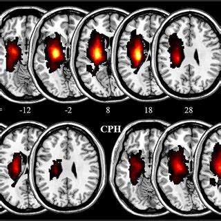 Lesion Distribution Map For Stroke PPH And CPH Patients The Color