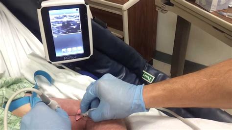 Piv Insertion With Preview Ultrasound Youtube