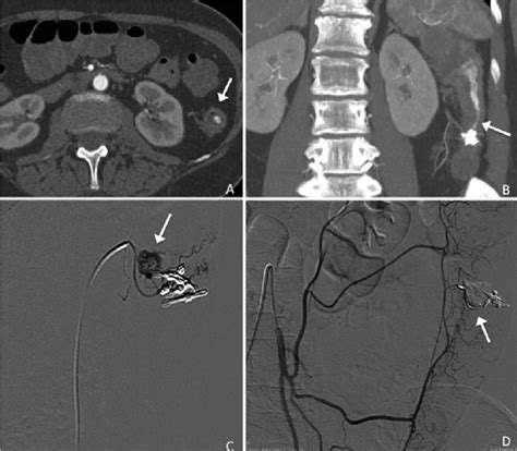 Contrast Enhanced Ct Revealed Arterial Bleeding Of A Diverticulum