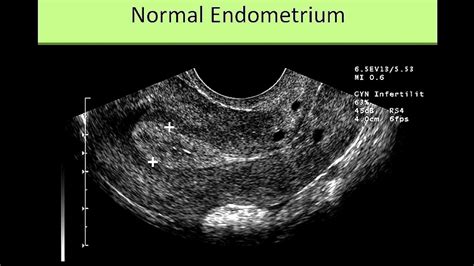 Thickness Of Uterine Lining After Menopause - Menopause Choices