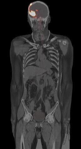 Whole Body Pet Ct Scan Shows Biodistribution Min After Intralesional