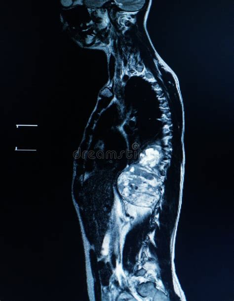 Mri Van Thoracolumbar Wervelkolom Matig Tot Ernstig Compressiefractuur