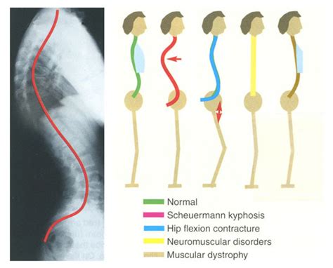 SCOLIOSIS INDIA: Kyphosis Exercises