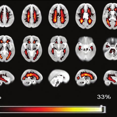 Lesion Frequency Map For Our Group Of Patients With Ms Indicating