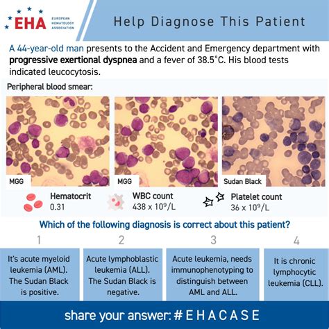 European Hematology Association On Twitter Hello And Welcome To The