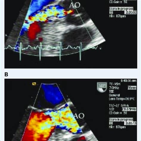 Left Ventricular Outflow Tract Lvot Became Severely Stenotic During