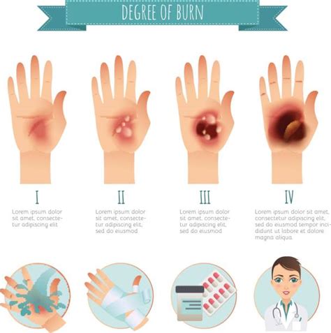 Skin Burn Illustrations Royalty Free Vector Graphics And Clip Art Istock