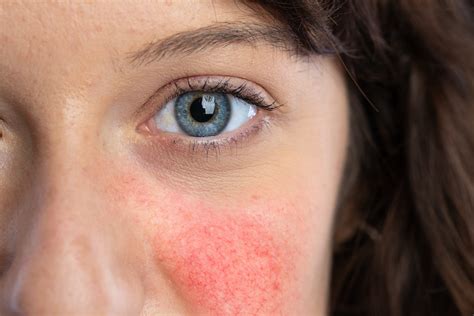 4 Ways To Naturally Manage Rosacea