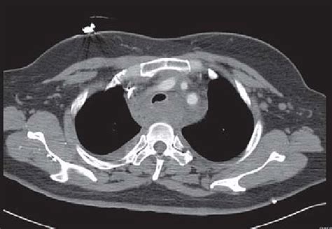 Contrast Enhanced Computed Tomography Chest At The Level Of The Aortic