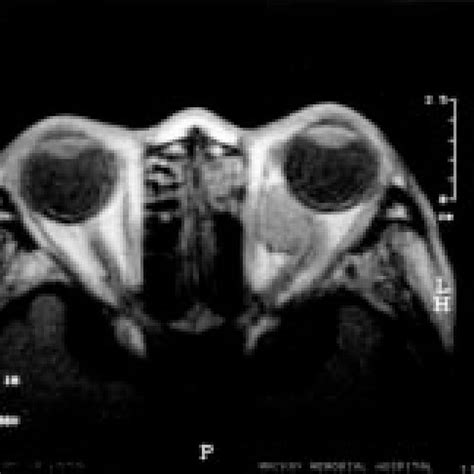 A retrobulbar tumor, shown on MRI, displacing the optic nerve upward... | Download Scientific ...